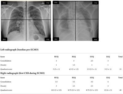 The impact of reduction in intensity of mechanical ventilation upon venovenous ECMO initiation on radiographically assessed lung edema scores: A retrospective observational study